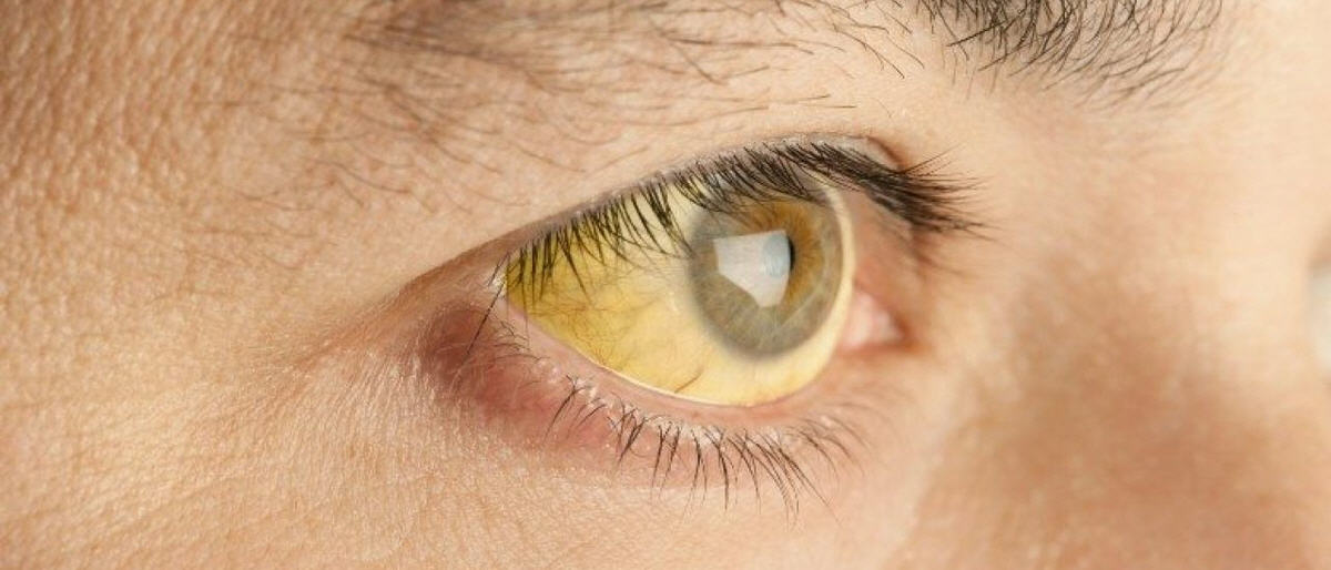 Hepatit B Virüs Enfeksiyonu